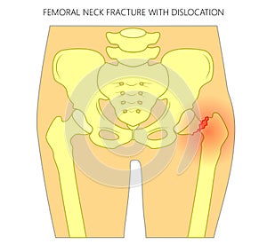 Pain in the hip joint_femoral neck fracture with dislocation