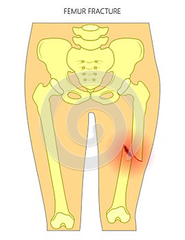 Pain in the hip joint_femur fracture photo