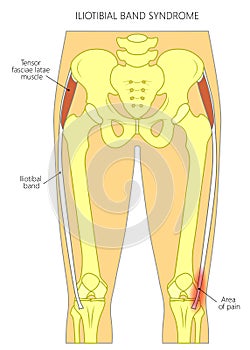 Pain in the hip joint iliotibial band syndrome photo