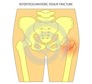 Pain in the hip joint_intertrochanteric femur fracture