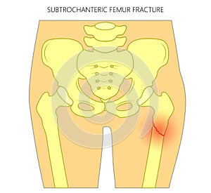 Pain in the hip joint_subtrochanteric femur fracture