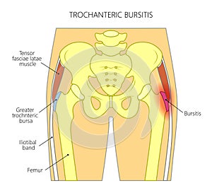 Pain in the hip joint_trochanteric bursitis