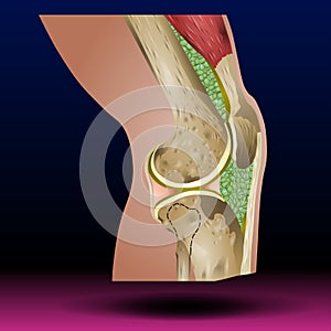 Pain, Injury and Inflammation, Knee Joint Pain Silhouette Icon Ache of Knee, Leg Skeleton, Arthritis, Osteoporosis and Bones Joint