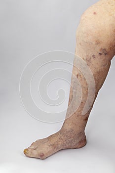 Pain syndrome and deformation of the foot with arthritis. Varicose veins in the legs.