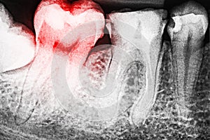 Pain Of Tooth Decay On X-Ray