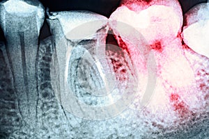 Pain Of Tooth Decay On X-Ray