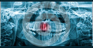 Pain Of Tooth Decay On Teeth X-Ray