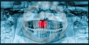 Pain Of Tooth Decay On Teeth X-Ray