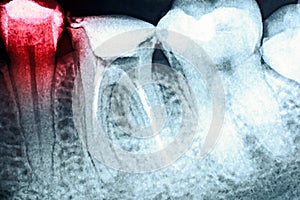 Pain Of Tooth Decay On X-Ray