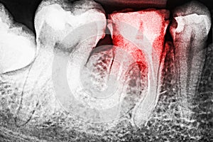 Pain Of Tooth Decay On X-Ray