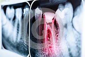 Pain Of Tooth Decay On X-Ray