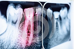 Pain Of Tooth Decay On X-Ray photo