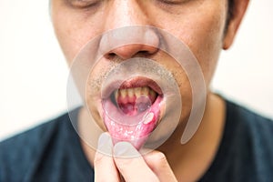 Pained aphtha ulcer mouth from accident