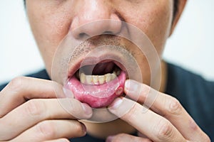 Ulcera sul bocca 