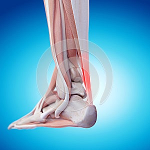 Painful achilles tendon photo