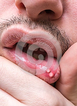 Painful aphtha ulcer on man's mouth