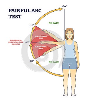 Painful arc test and physiopedia syndrome medical diagnosis outline diagram photo