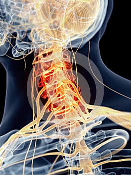 Painful cervical nerves