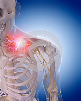 Painful cervical nerves