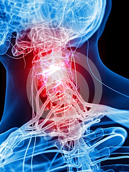 Painful cervical nerves