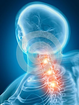 A painful cervical spine