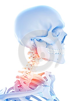 Painful cervical spine