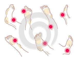 Painful feet and legs with ache mark collection. Muscle pain, medical and medicine concept. Isolated vector illustration