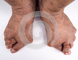 Painful gout inflammation of foot