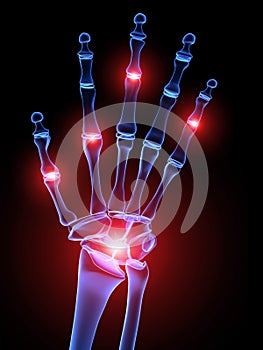 Painful hand joints