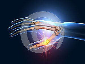 Painful hand joints, medical 3D illustration