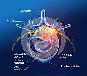 Painful herniated disk, medically 3D illustration on black background