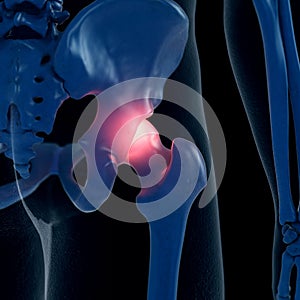 A painful hip joint