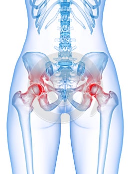 a painful hip joint