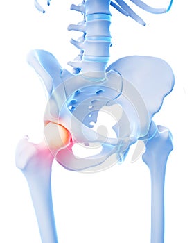 Painful hip joint