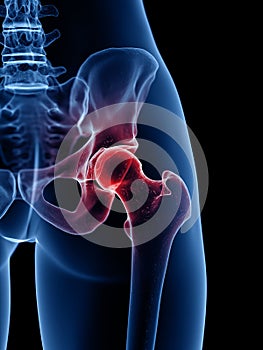 A painful hip joint
