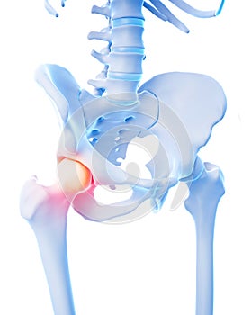 Painful hip joint photo