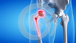 a painful hip replacement