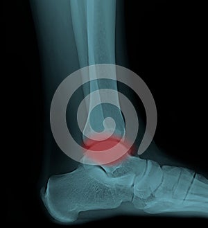 Painful human right foot ankle xray picture internal side