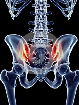 Painful iliosacral joint