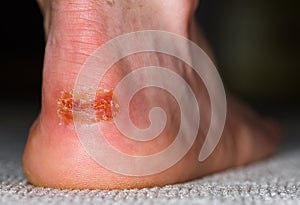 Painful injury on heel