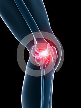 Bolestivý koleno 