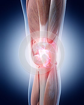 Painful knee