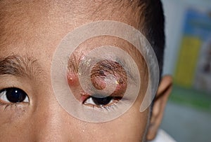 Painful, large abscess or Staphylococcal / Streptococcal skin infection or carbuncles in face of Southeast Asian Burmese child. photo