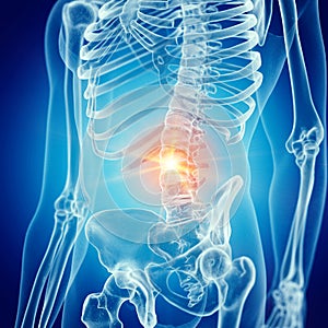 a painful lower back