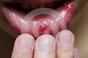 Painful mouth ulcerr of woman`s mouth