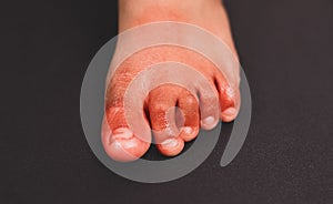 Painful red inflammation on toe called covid toe lesions strange sign of new coronavirus symptoms or infections photo