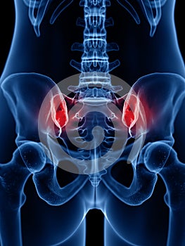 A painful sacroiliac joint