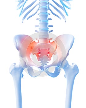 Painful sacrum photo