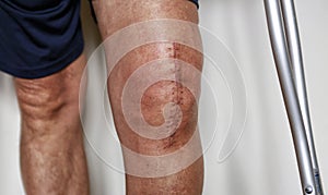 Painful scar after knee surgery