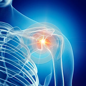 A painful shoulder joint